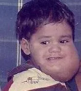 Cystic hygroma