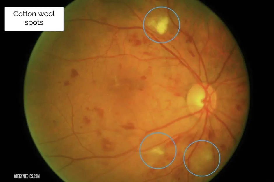 Cotton wool spots in pre-proliferative diabetic retinopathy