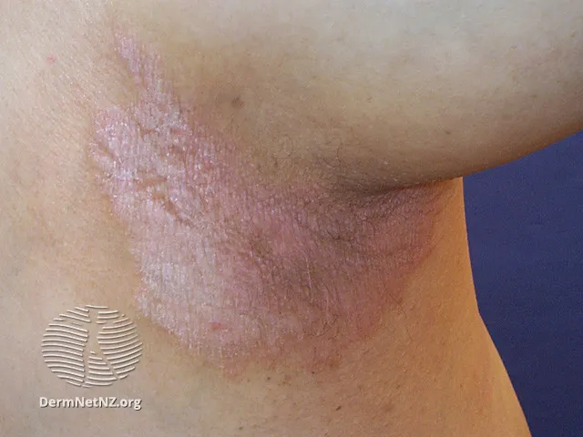 Flexural psoriasis