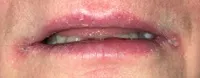 Angular cheilitis