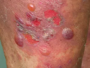 Bullous pemphigoid