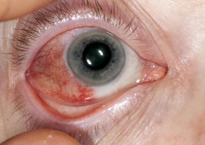 Episcleritis — segmental hyperaemia (lateral aspect here) mimicking conjunctivitis but with much less tearing and no discharge, and without the full bulbar+palpebral involvement seen in conjunctivitis