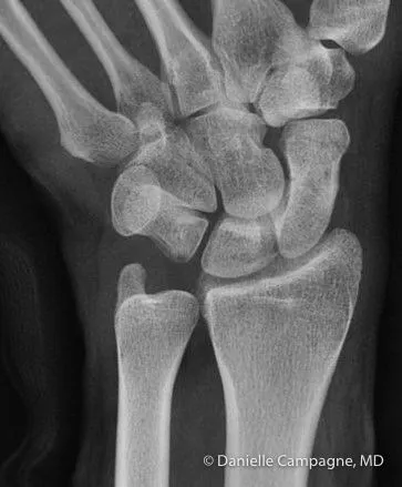 A "normal" wrist X-ray in a patient with snuffbox tenderness — don't be reassured