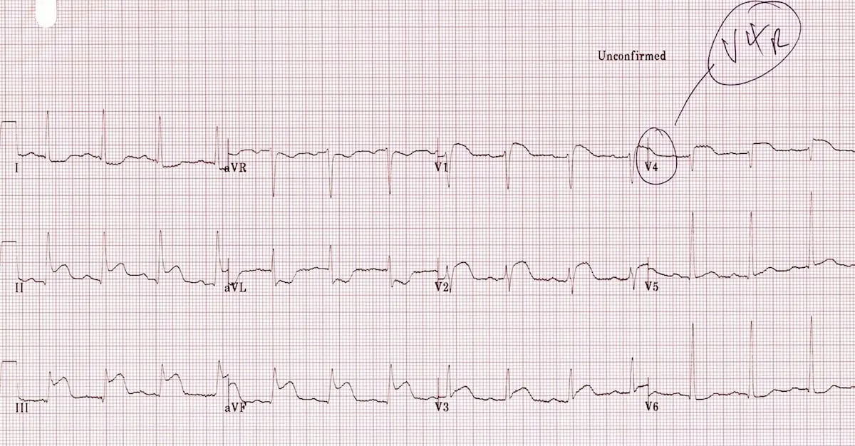 ECG example
