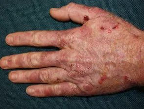 Porphyria cutanea tarda