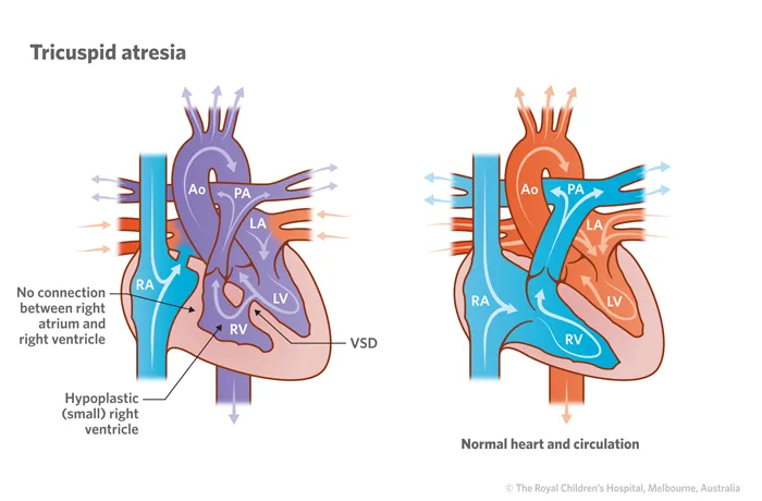 Tricuspid atresia