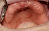 Denture-associated erythematous stomatitis