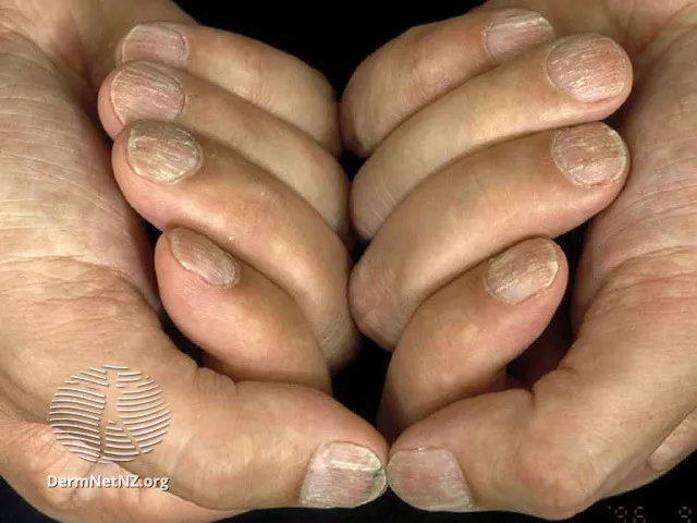 Alopecia areata nail changes