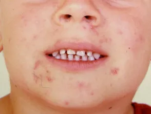 Infantile acne