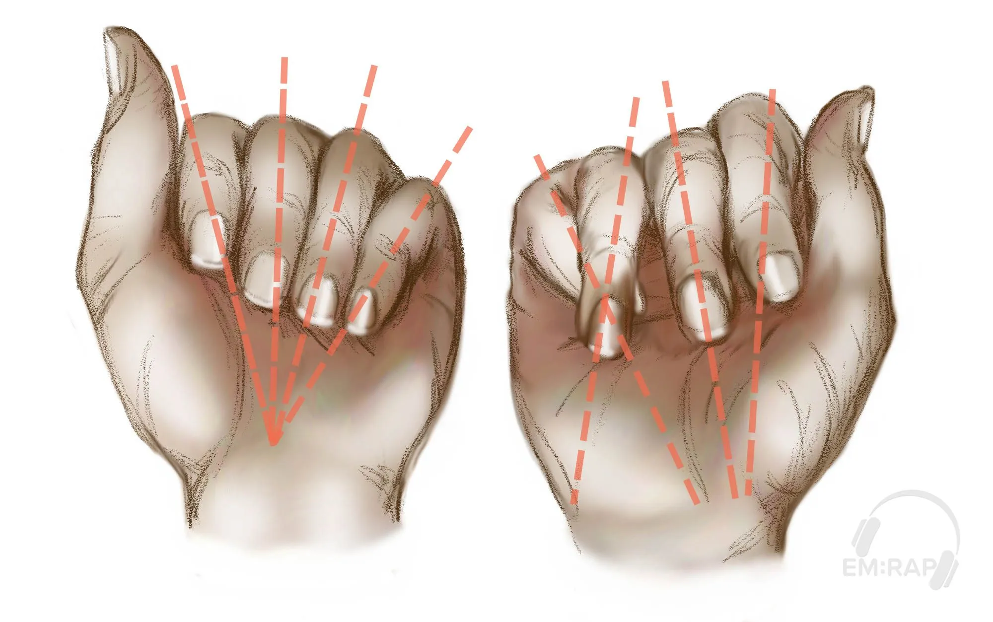 Checking rotational alignment — fingers should converge toward the scaphoid, not cross