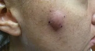 Atypical mycobacterial infection