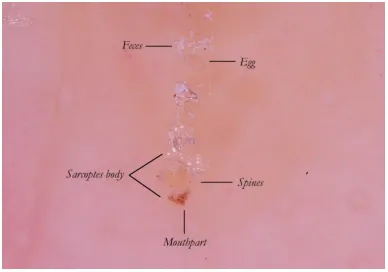 Scabies mite anatomy