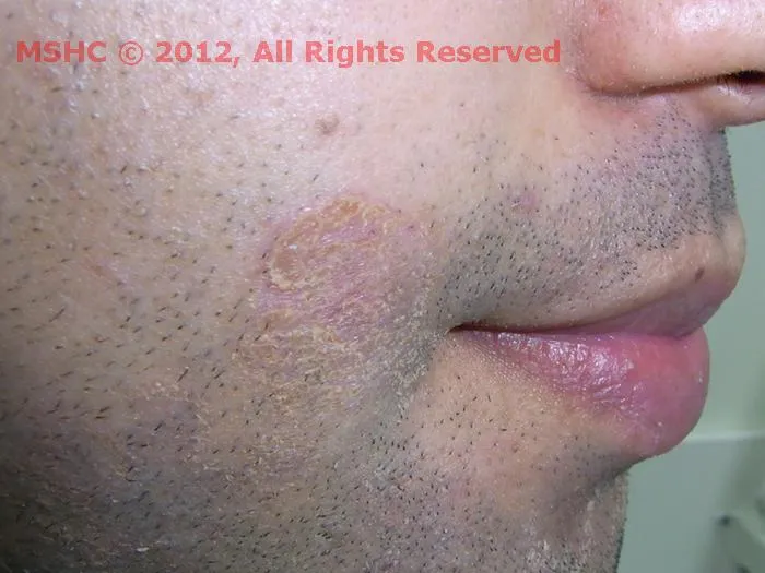 Secondary syphilis