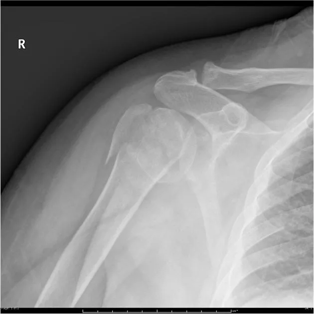 Proximal humerus fracture — greater tuberosity + surgical neck