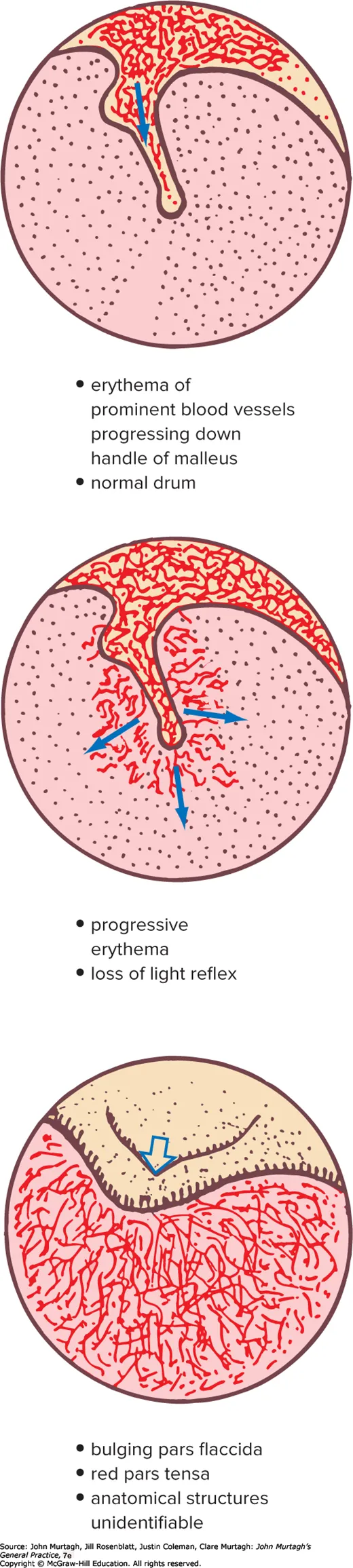 Progressive tympanic membrane appearances in AOM
