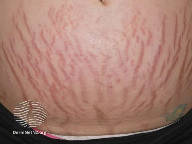 Striae gravidarum