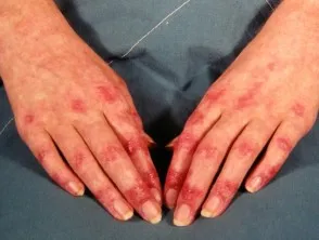 Dermatomyositis of the hand