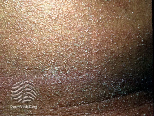 Miliaria
