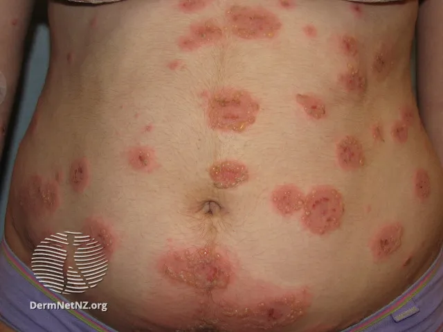 Pemphigoid gestationis