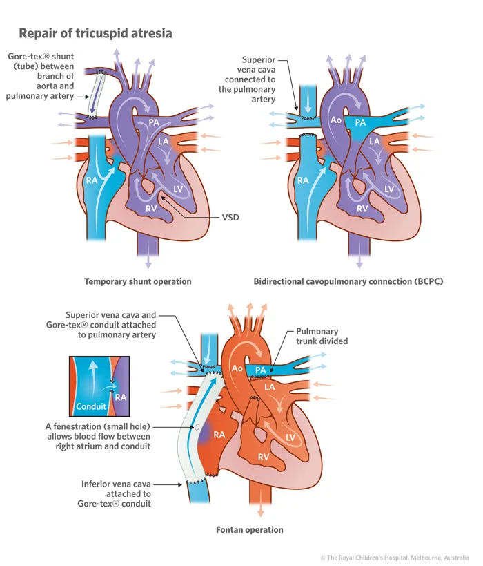 Fontan circulation