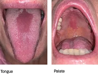 Median rhomboid glossitis