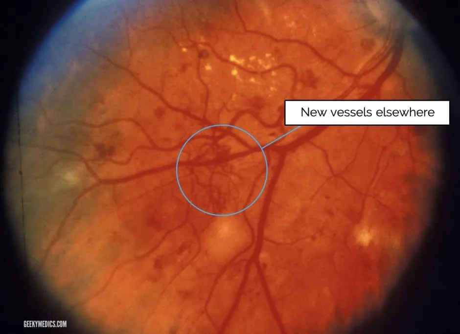 Neovascularisation