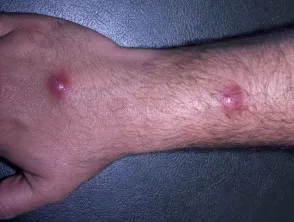 Atypical mycobacterial infection