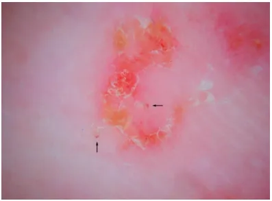 Scabies burrows