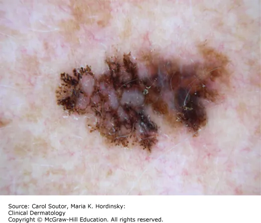 Melanoma structural asymmetry