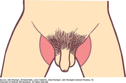 Dermogram for tinea cruris