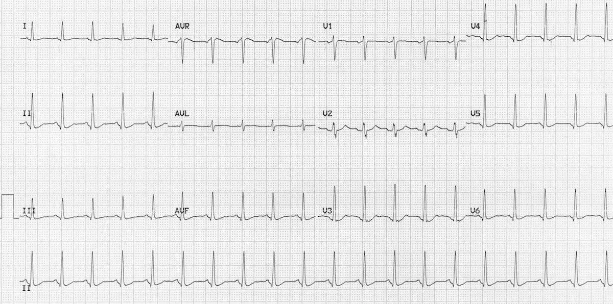 ECG showing marked T-wave/QT abnormality