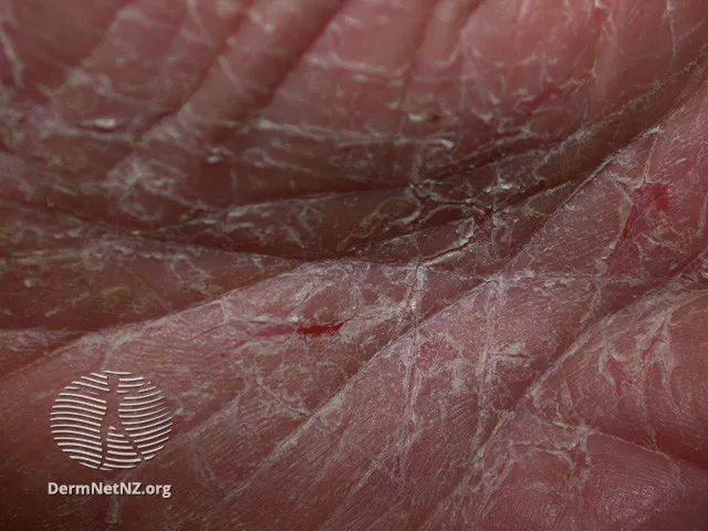 Acquired keratoderma