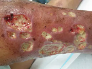 Atypical mycobacterial infection
