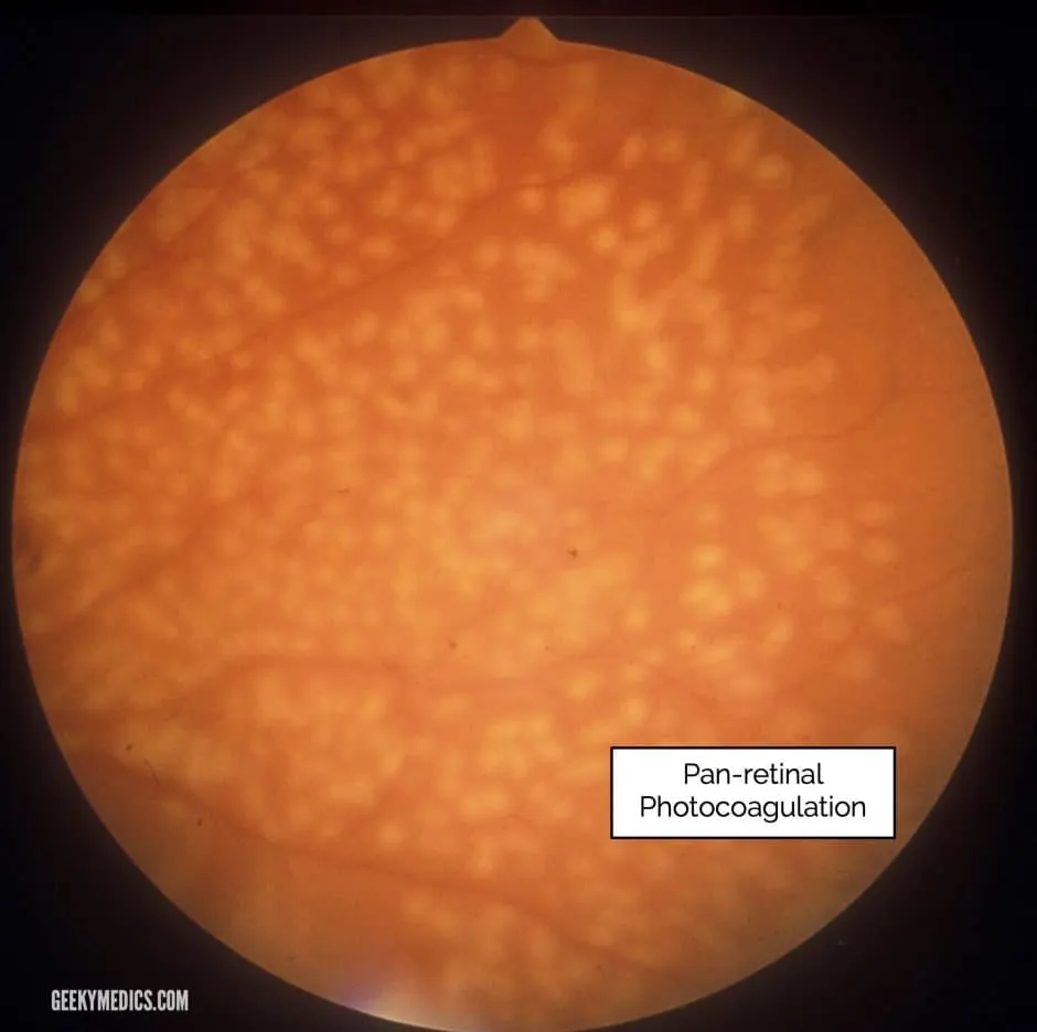 Pan-retinal photocoagulation