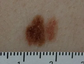 Atypical naevus