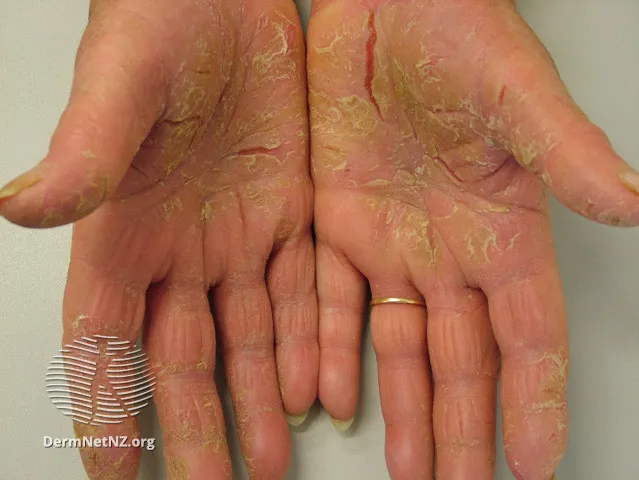 Palmoplantar psoriasis