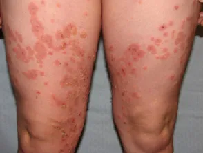 Pemphigoid gestationis