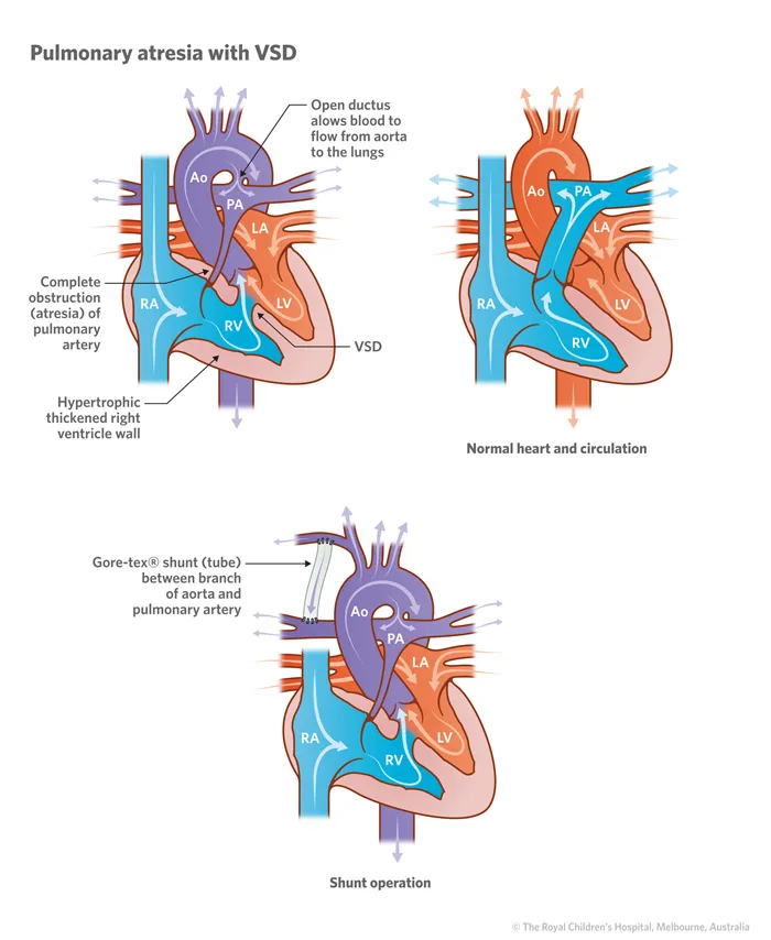 Pulmonary atresia with VSD