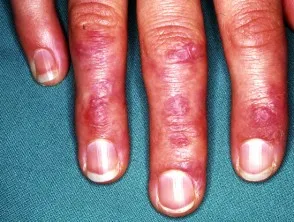 Dermatomyositis of the hand