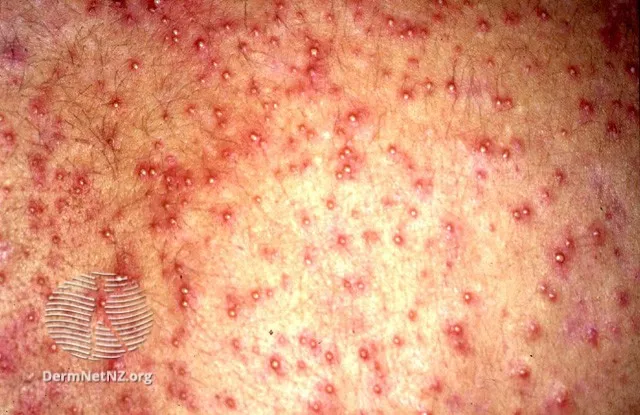 Miliaria