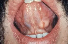 Salivary gland tumour