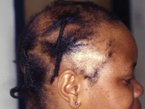 Traction alopecia