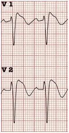 Brugada sign — coved ST segments in V1/V2
