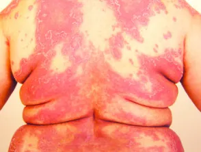 pustular psoriasis