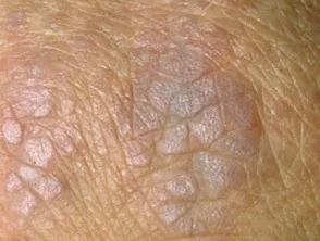 Dermatomyositis