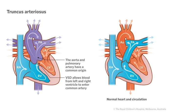 Truncus arteriosus