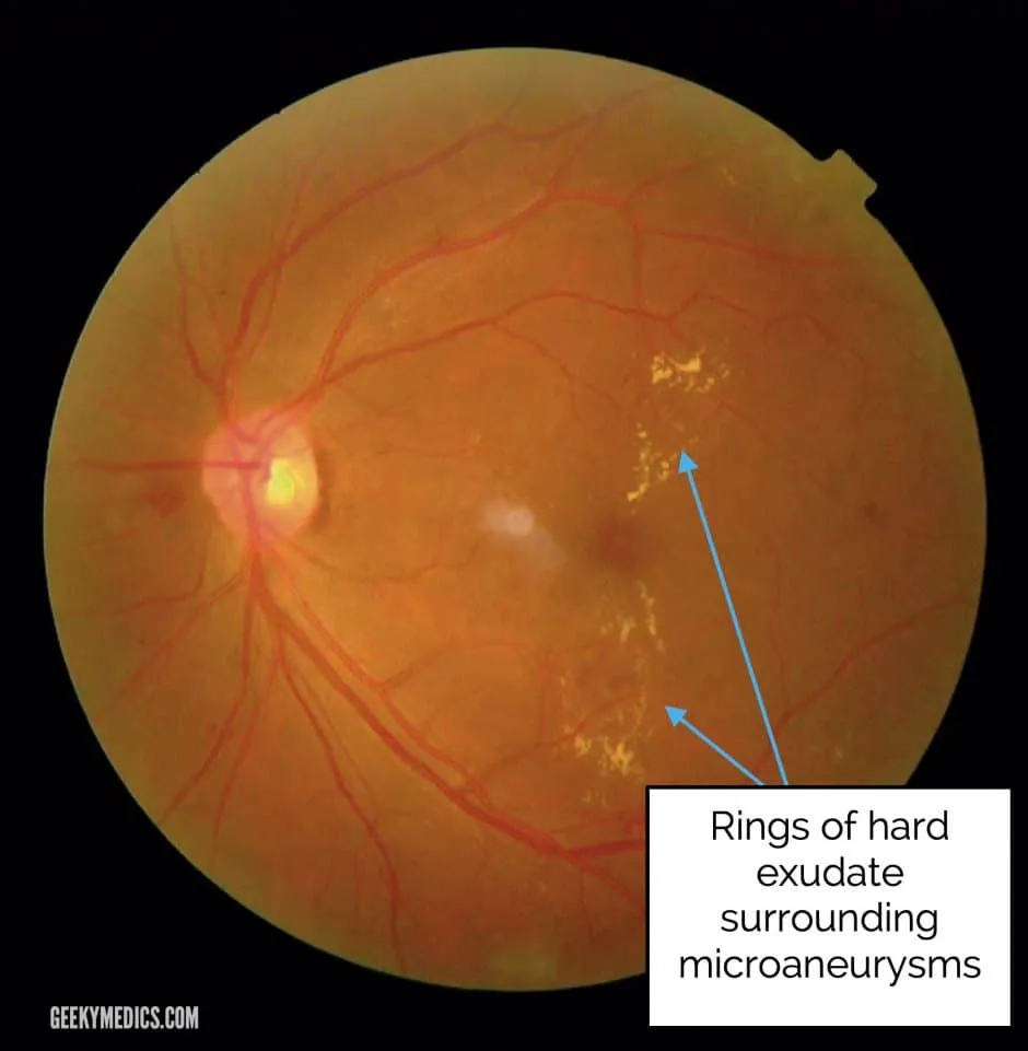Hard exudates in diabetic retinopathy