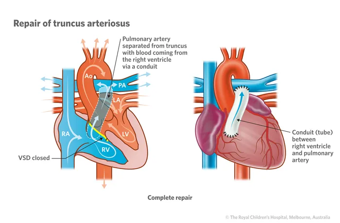 Truncus arteriosus repair