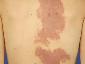 Port wine stain
