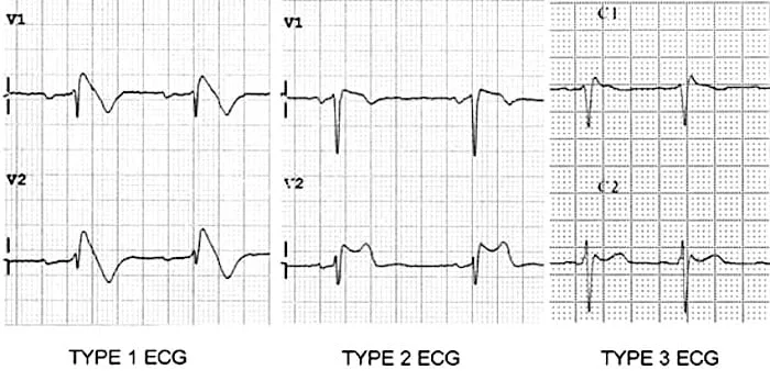 Brugada syndrome types 1-3